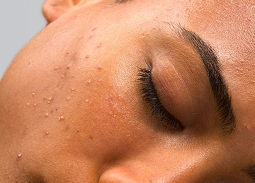 Why is My Skin Looks so Oily? Understanding Your Skin